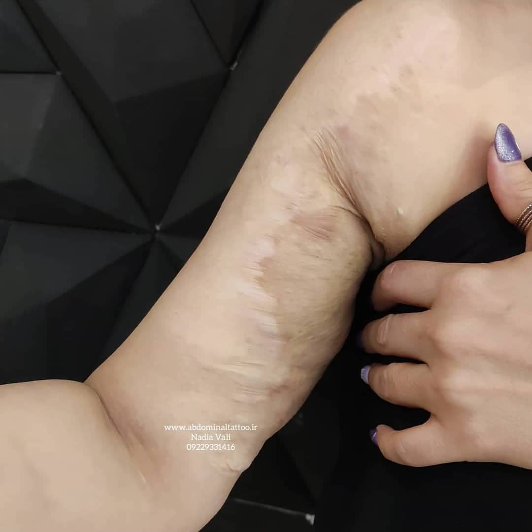 تاتو ظریف زنانه کاور سوختگی روی بازو
