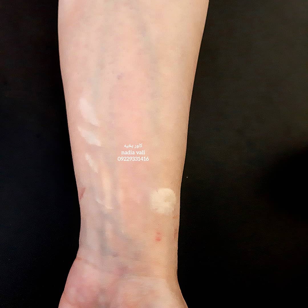 تاتو کاور لک پوستی روی دست