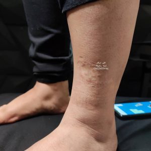 تاتو کاور زخم روی ساق پا