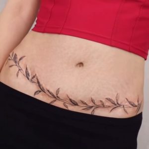 پوشش اسکار ابدومینوپلاستی با طرح شاخه و برگ