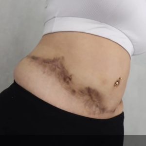 نمونه اسکارهای واقعی جراحی ابدومینوپلاستی